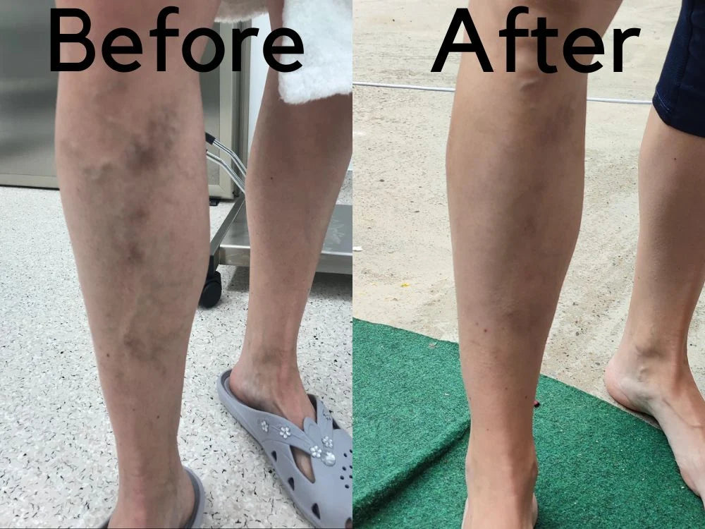 Varicose Vein Laser