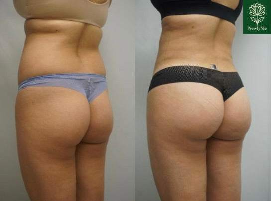 Electric Buttocks Muscle Toner