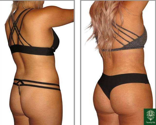Before and after photos showing buttocks tone improvement using Electric Buttocks Muscle Toner for sculpted, lifted glutes