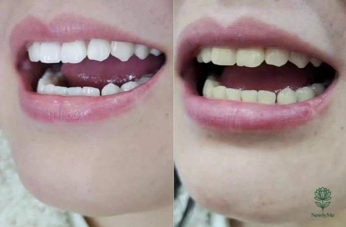 Magical Teeth Whitening Pen