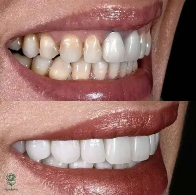 Magical Teeth Whitening Pen