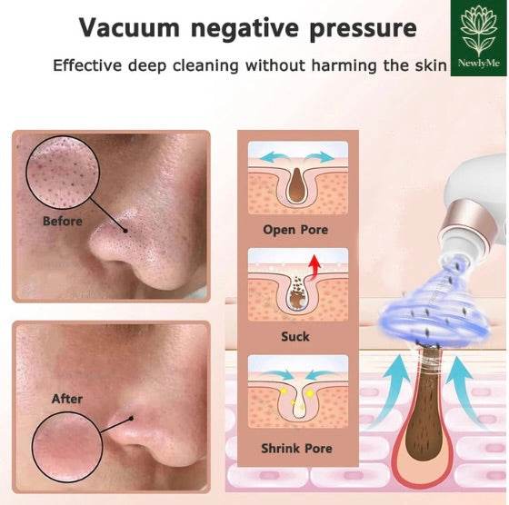 Blackhead remover electric face cleaner showing before and after results with vacuum suction deep pore cleansing diagram