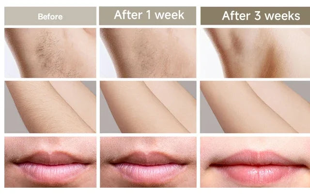 Permanent Laser Hair Removal