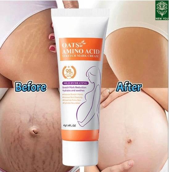 Permanent Stretch Marks Removal Cream