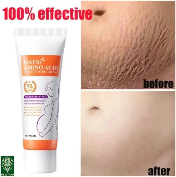 Permanent Stretch Marks Removal Cream