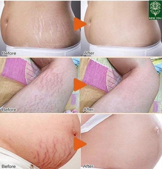 Permanent Stretch Marks Removal Cream