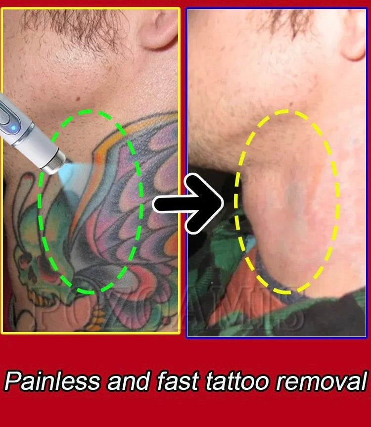 Tattoo Removal Laser Pen