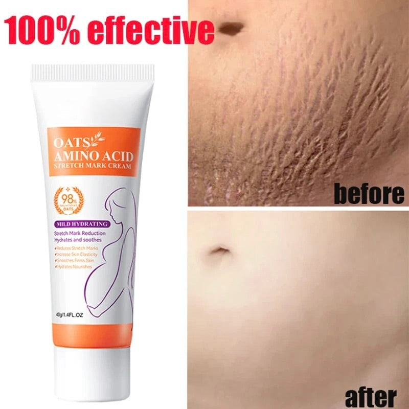 Permanent Stretch Marks Removal Cream