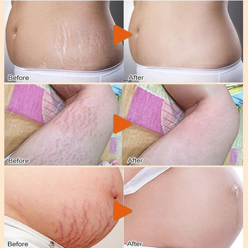 Permanent Stretch Marks Removal Cream