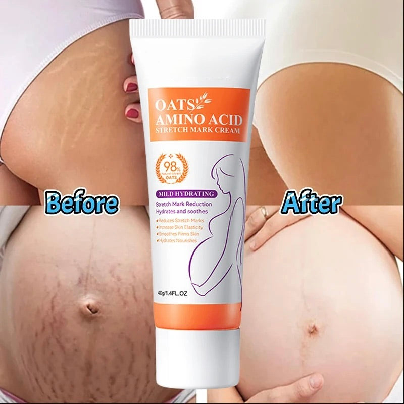 Permanent Stretch Marks Removal Cream