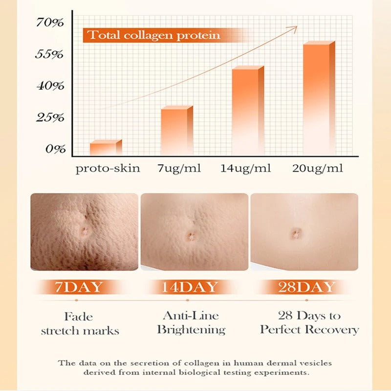 Permanent Stretch Marks Removal Cream