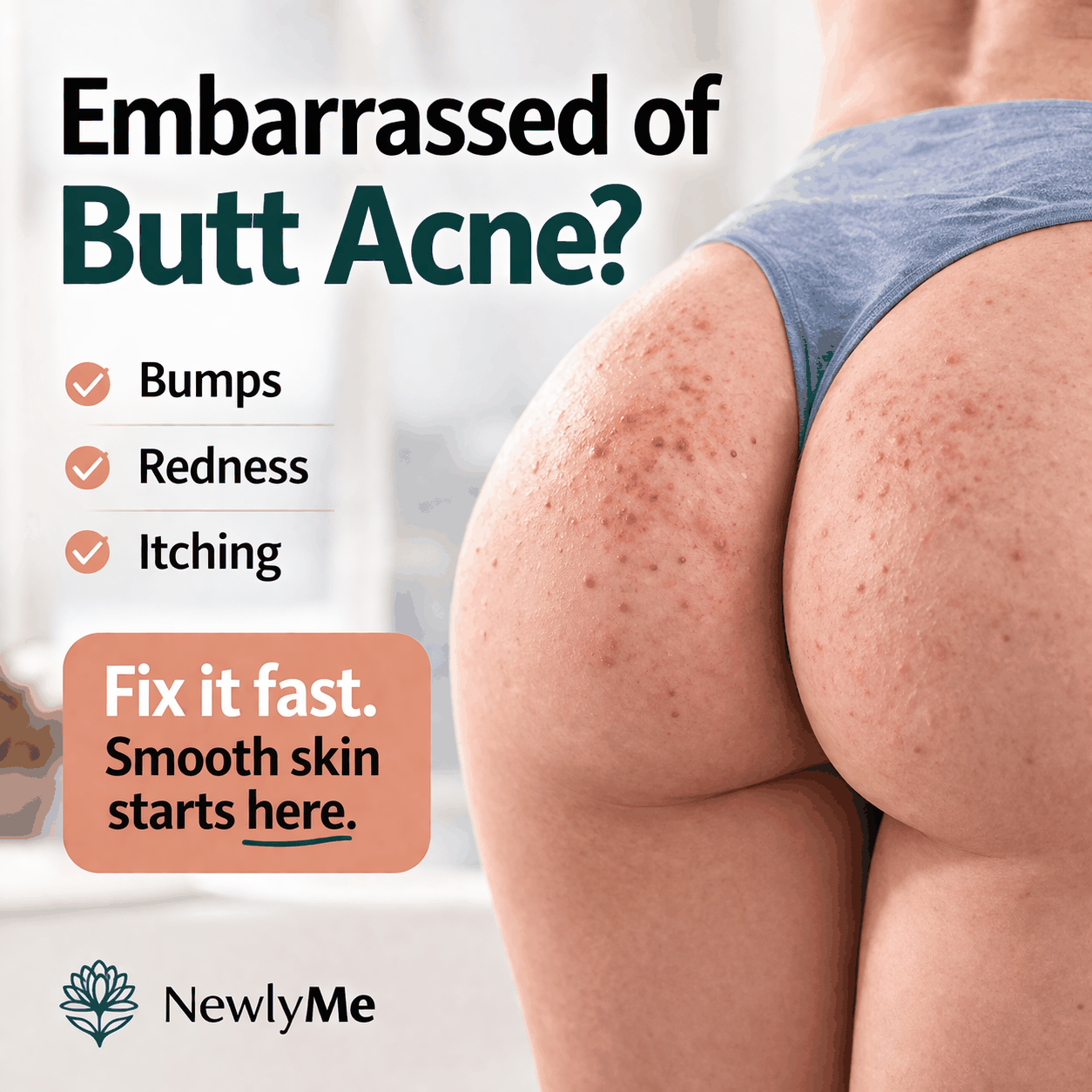 Butt Acne Cream