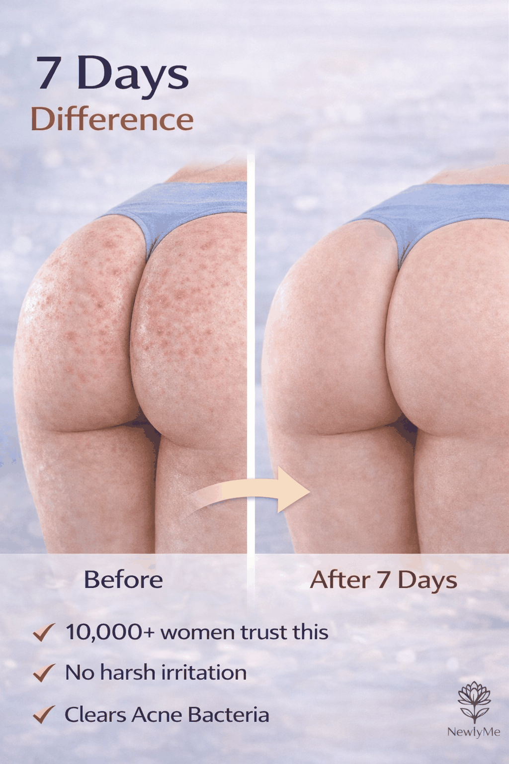 Butt Acne Cream