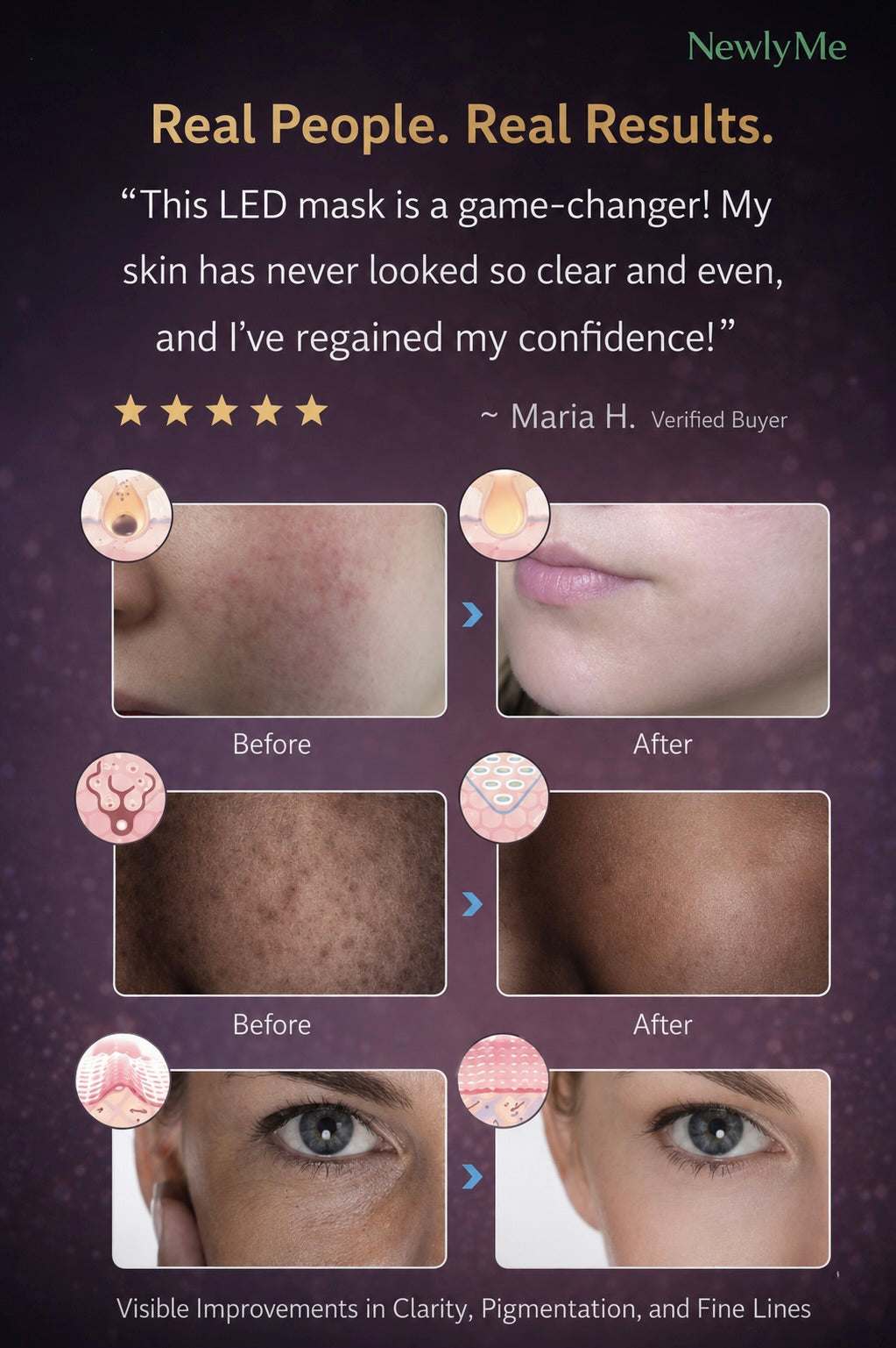 acne mask