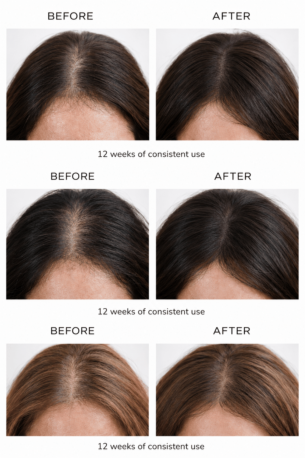 Laser Hair Growth