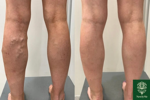 Varicose Vein Laser