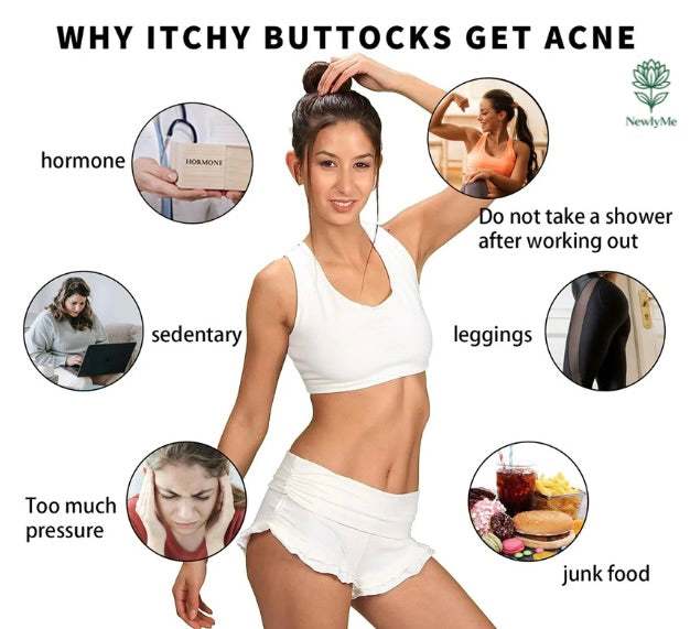 Butt Acne Cream