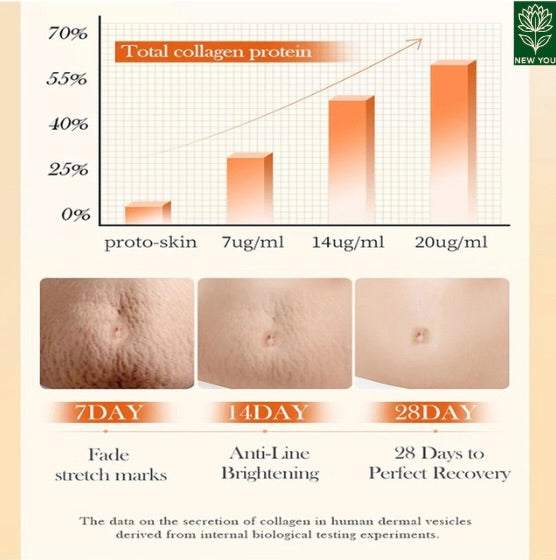 Permanent Stretch Marks Removal Cream