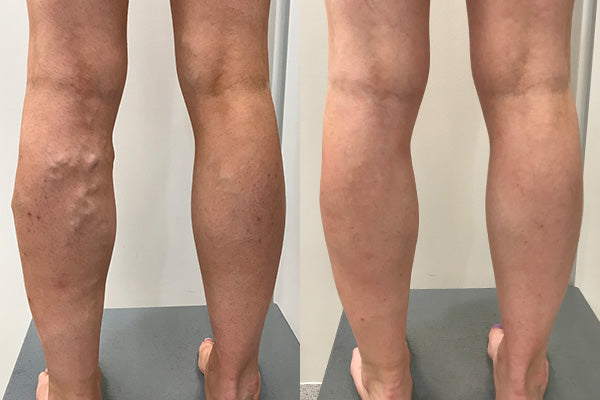 Varicose Vein Laser