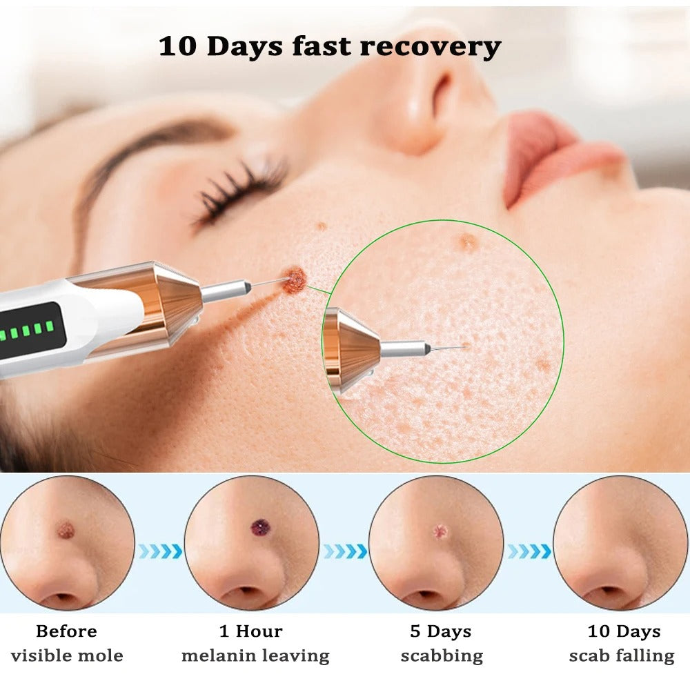 Skin Tag Remover Plasma Pen