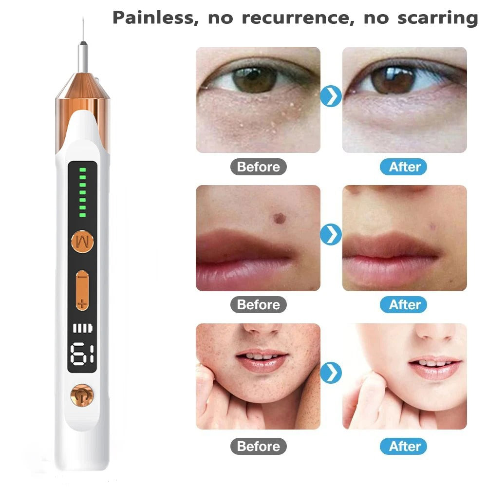 Skin Tag Remover Plasma Pen