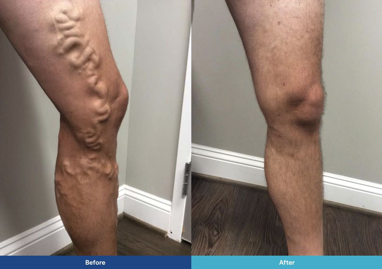 Varicose Vein Laser